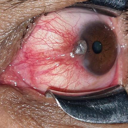 Tumores oculares y de superficie ocular