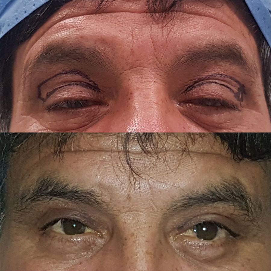 Blefaroplastia superior