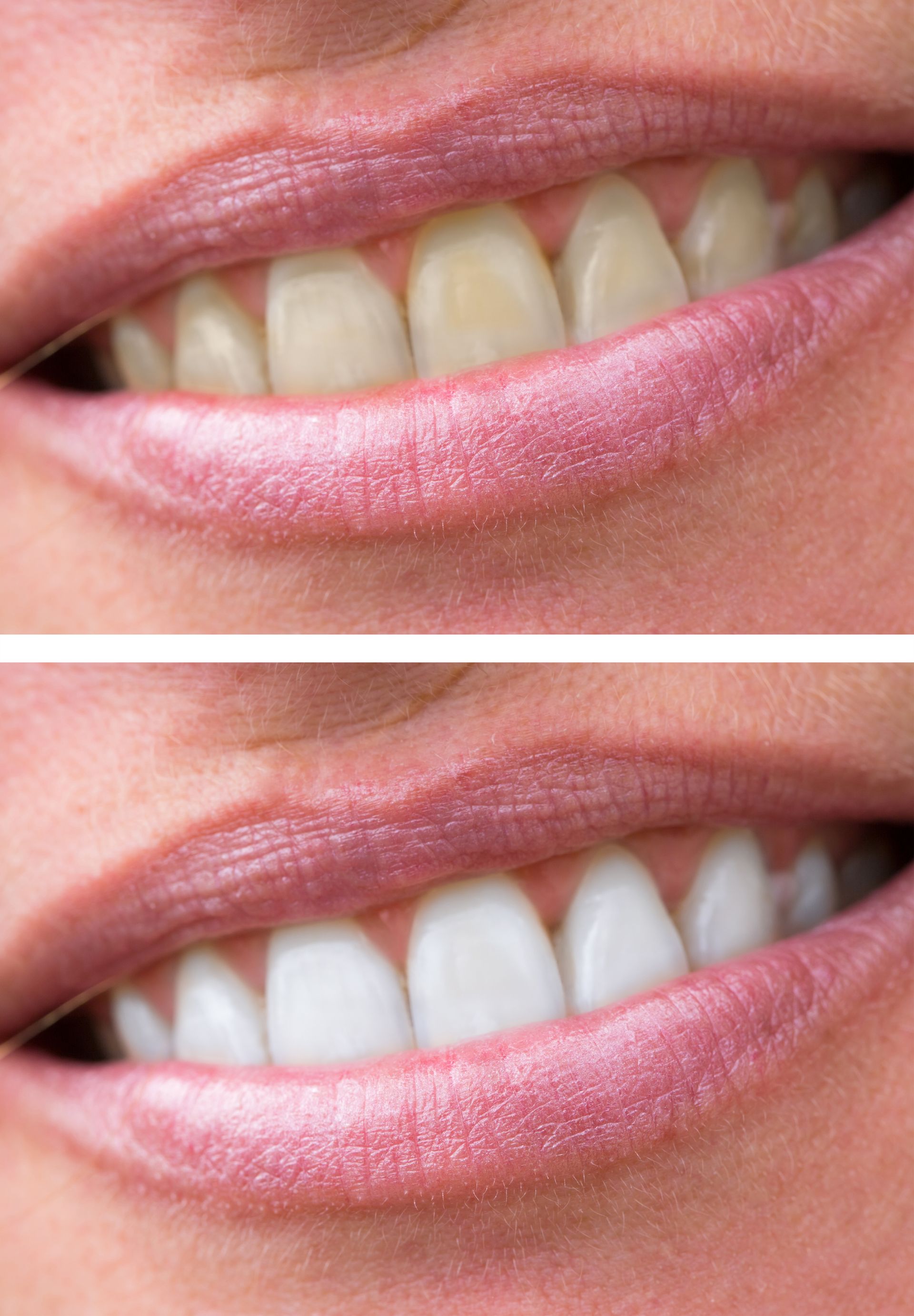 Before and after of a woman's teeth whitening treatment at Randal P. Ashton, DDS, in Danville, IL, revealing bright, beautiful results.