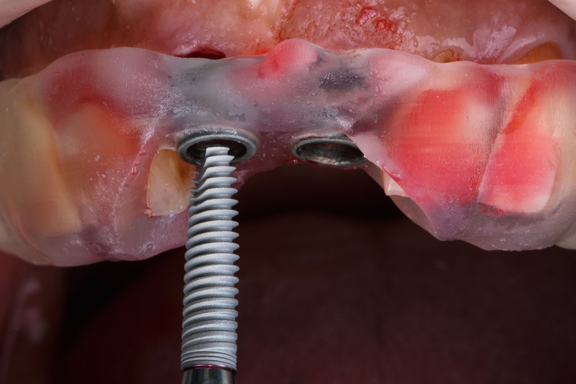 Crown Implants | East Alton, IL