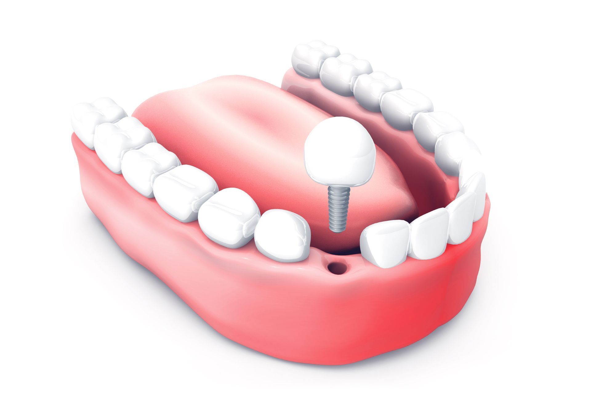 crown implants and treatment