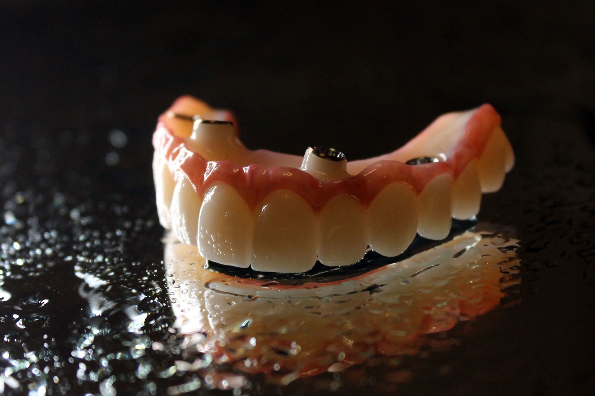 Dental Denture Implants Expectations