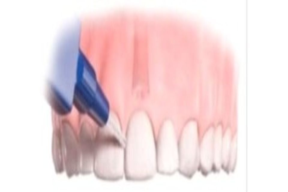 tecniche di sbiancamento dentale