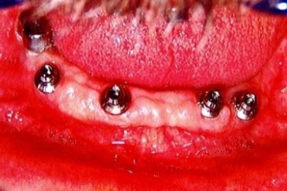 ponti dentali