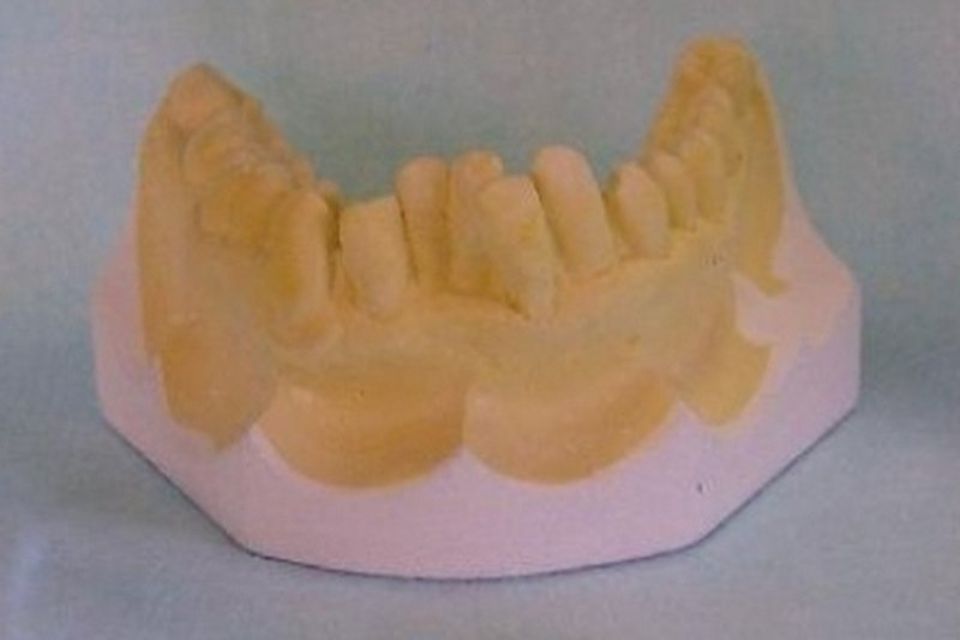 calco dentale