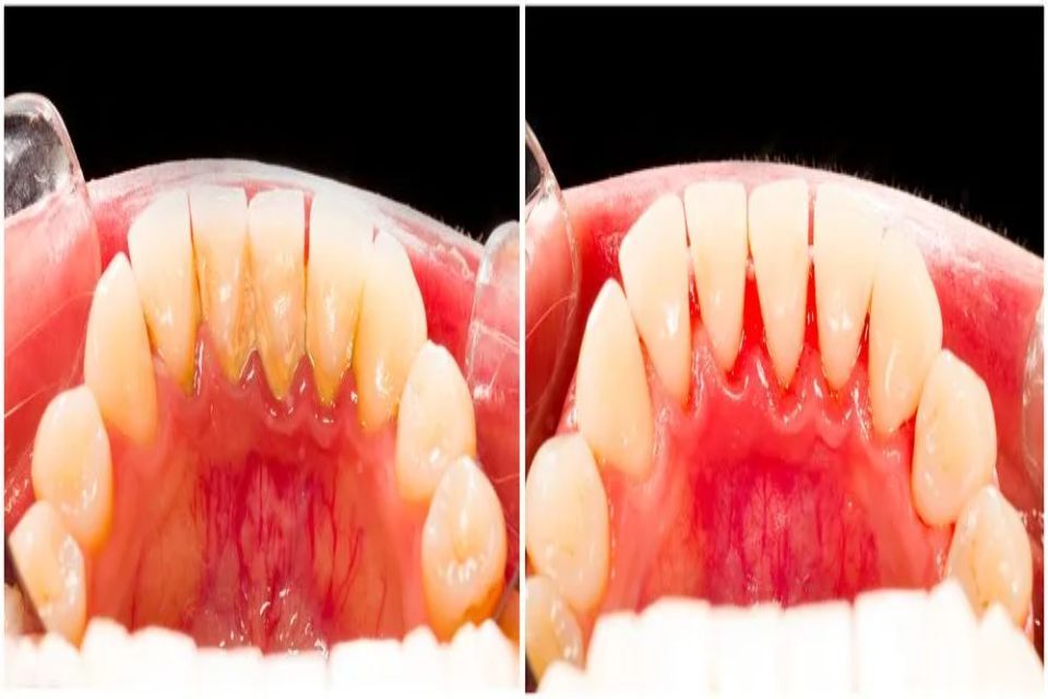 raddrizzamento arcata dentaria