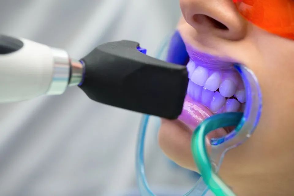 strumenti per lo sbiancamento dentale