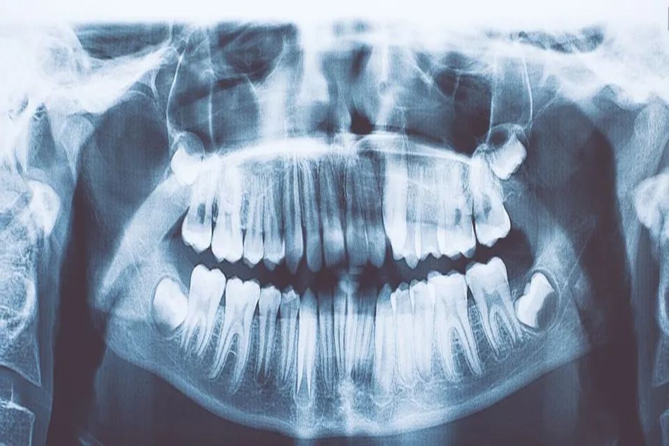 radiografie dell'arcata dentaria