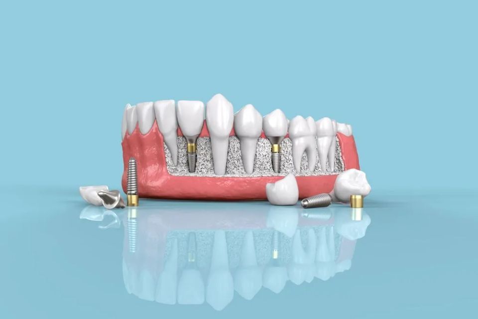 riproduzione di un impianto dentale