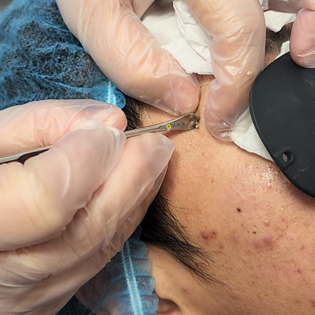 Glomax Aesthetics_Acne Facial Extraction