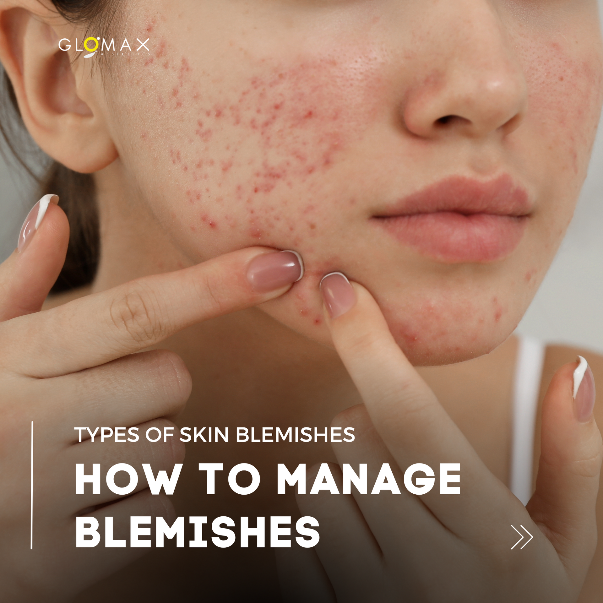 Understanding Blemishes: The Different Types and Their Causes