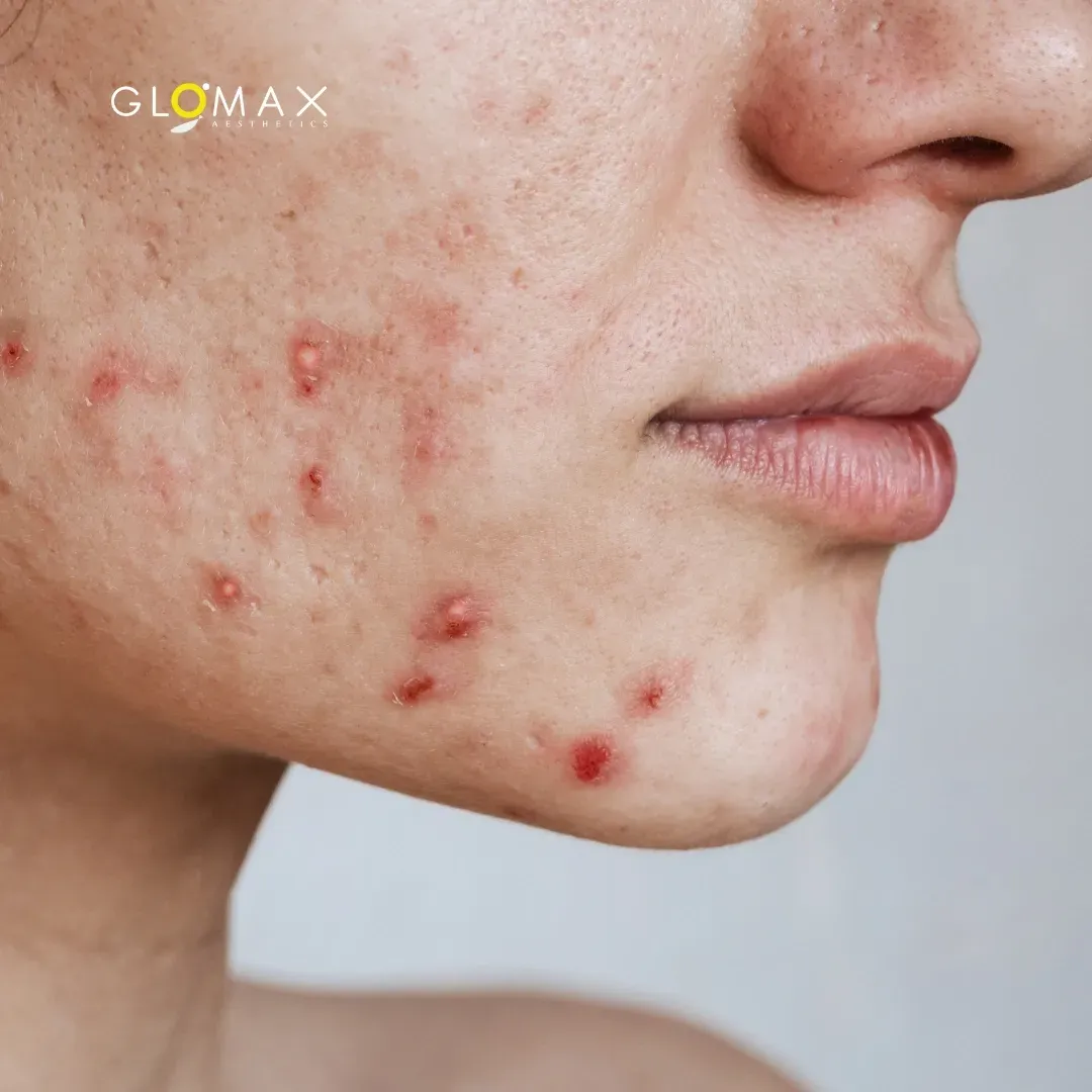 Top 5 Drinks That Can Trigger Acne (And What to Choose Instead)