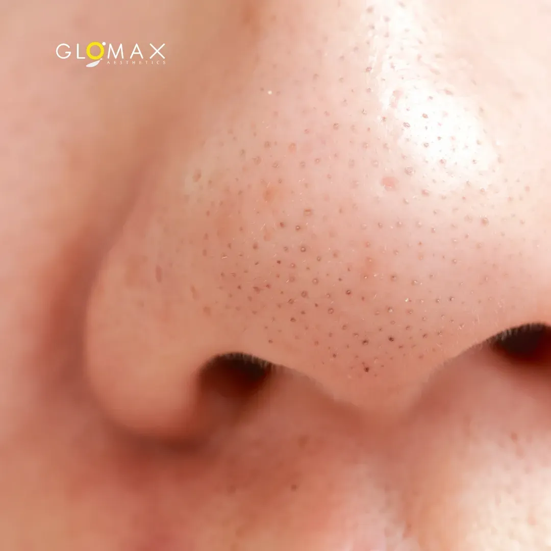 Blackheads, whiteheads, acne