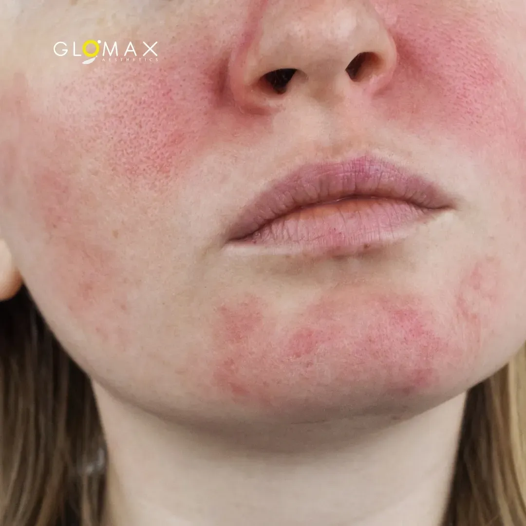 Redness, Rosacea, Sensitive