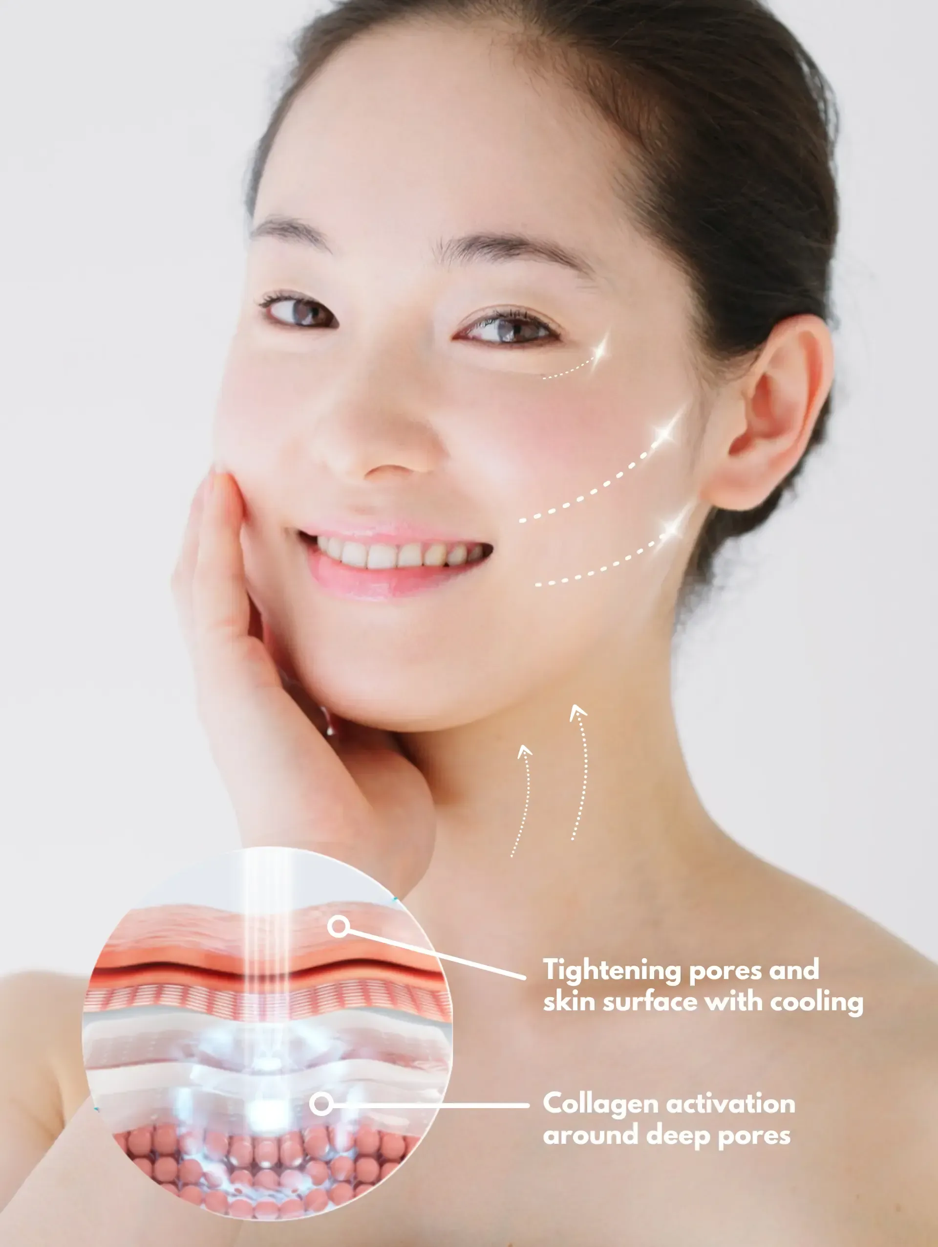 Coolfase RF - The Next-Gen, Painless Face Lift