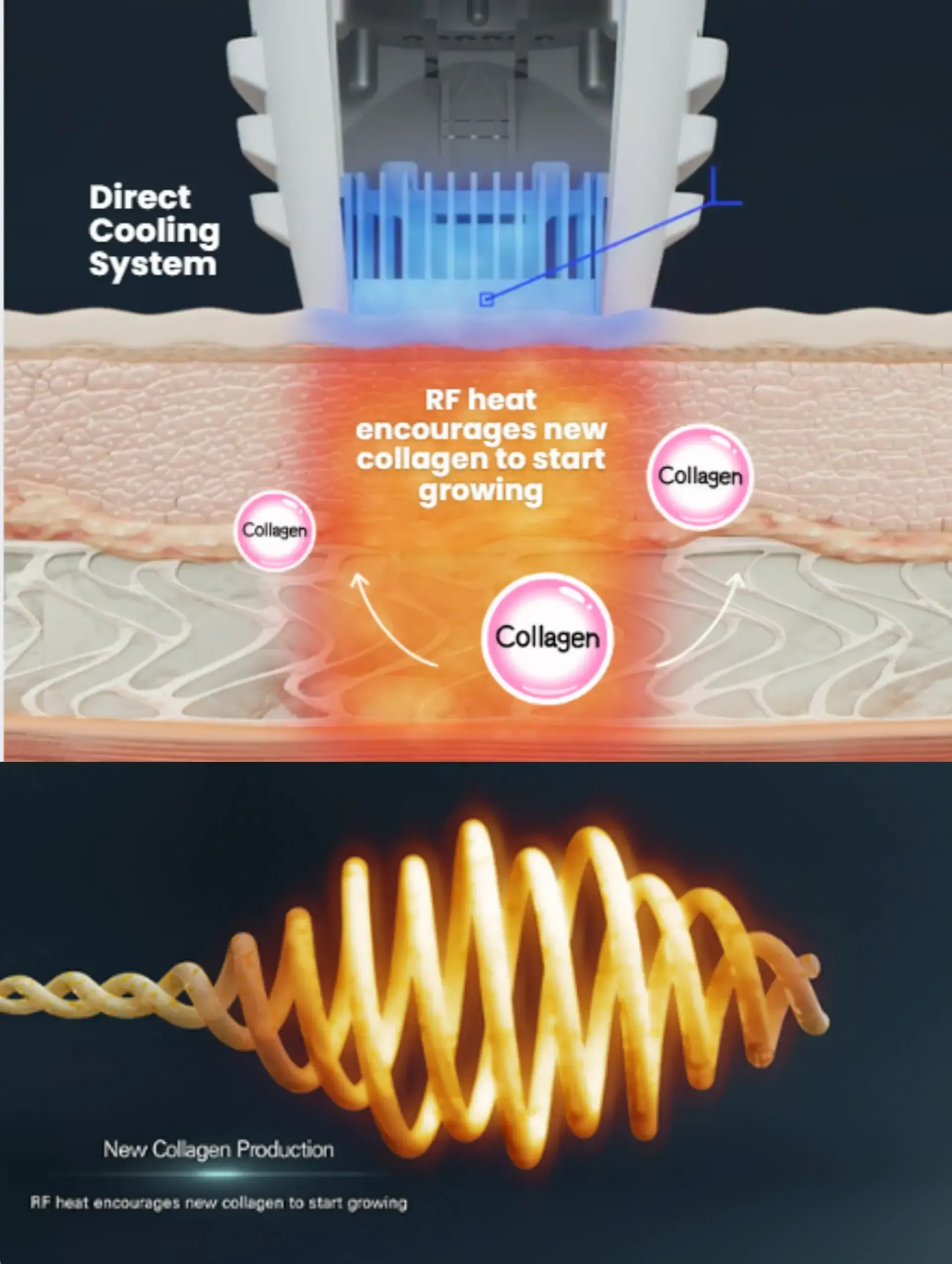 Coolfase RF: The Next-Gen, Painless Face Lift