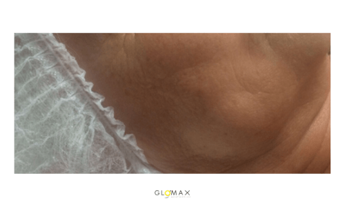 Glomax Aesthetics - WishPro MIT Repairing Treatment