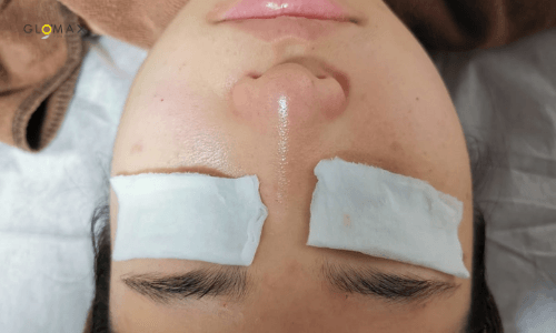 Glomax Aesthetics - BBL Acne After Treatment
