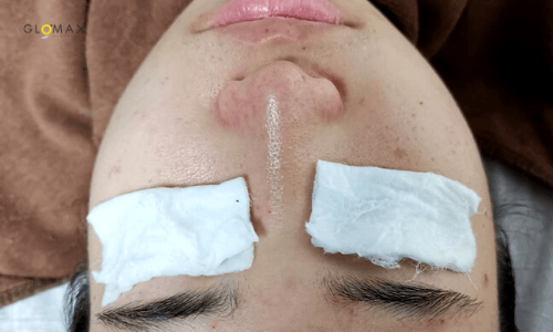 Glomax Aesthetics - BBL Acne Before Treatment