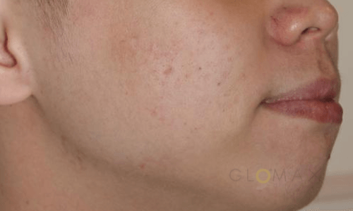 Glomax Aesthetics - BBL Acne AfterTreatment