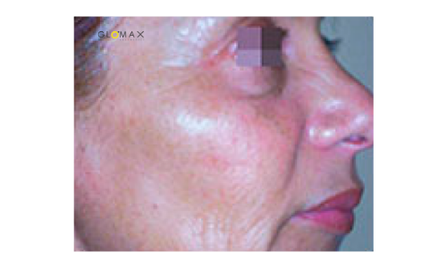 Glomax Aesthetics - Indiba RF Face Contour Treatment