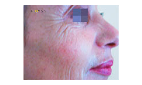 Glomax Aesthetics - Indiba RF Face Contour Treatment