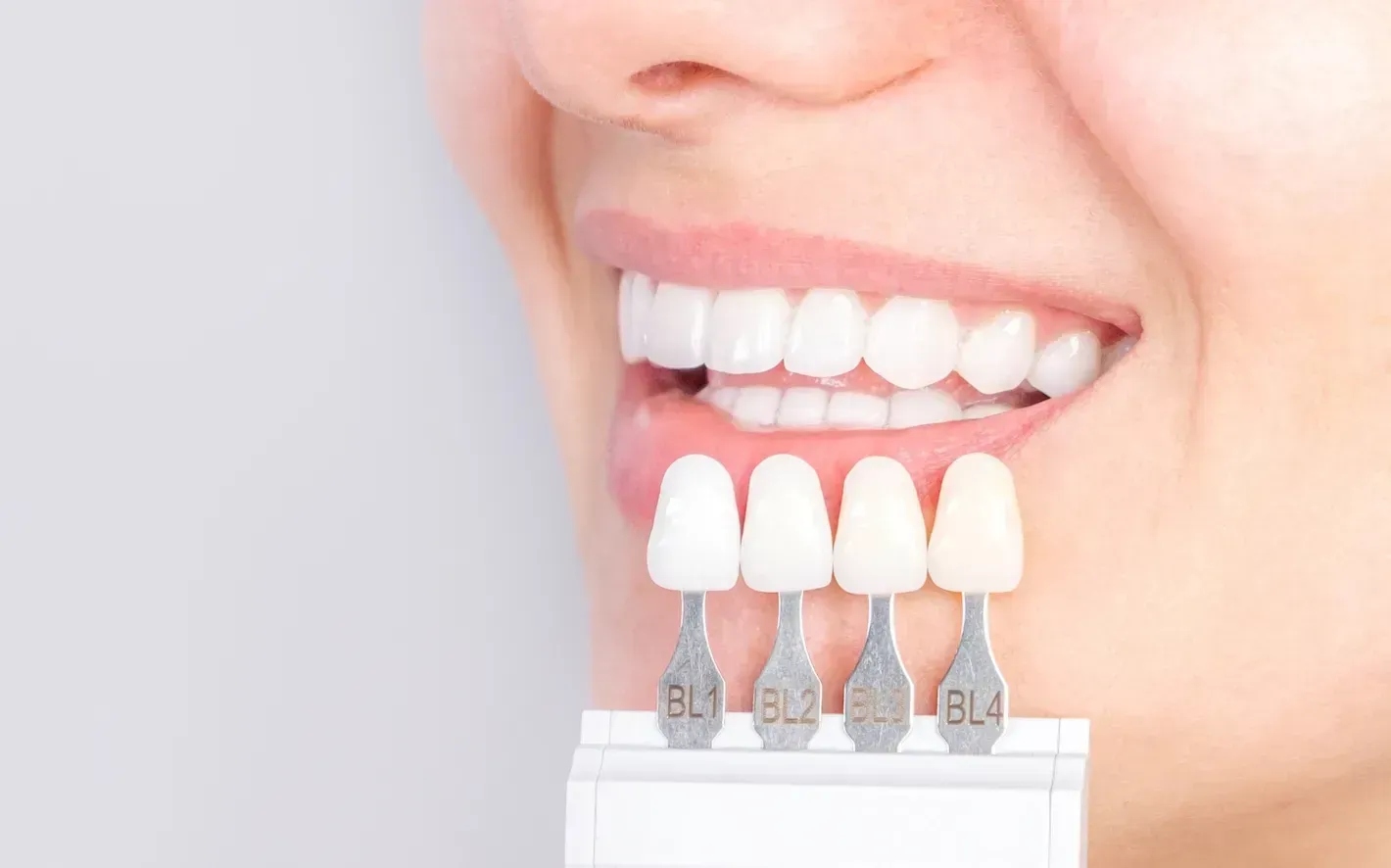 A close up of a woman 's teeth with a tooth color chart.