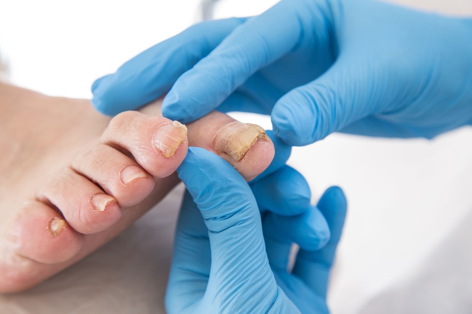A person's foot with a toenail being examined by a medical professional wearing blue gloves.