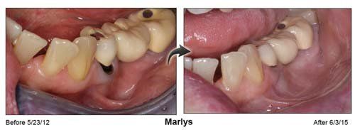 Teeth Operation — Maryls Teeth Before And After in Cleveland, OH
