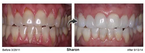 Gum — Sharon Teeth And Gums in Cleveland, OH