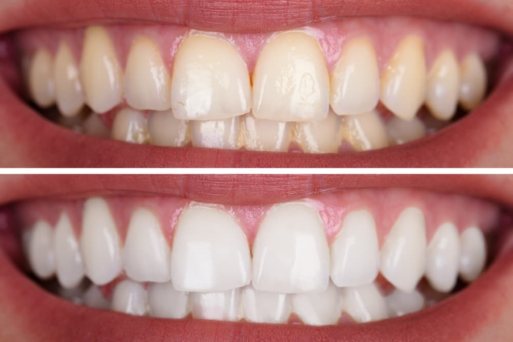 Before and After Cleaning — Dental Prosthetics in Labrador, QLD