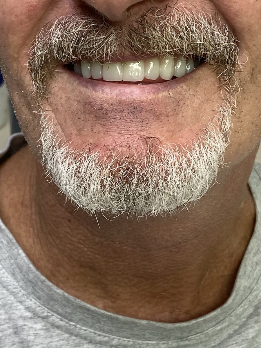 Man Sweet Smile — Dental Prosthetics in Labrador, QLD