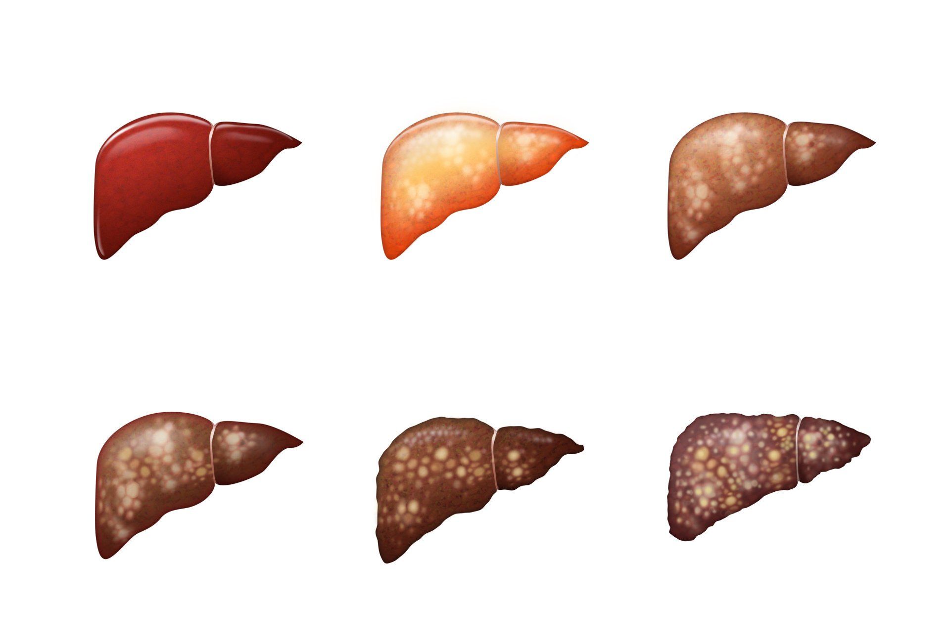 Illustrations of a progression of liver disease.