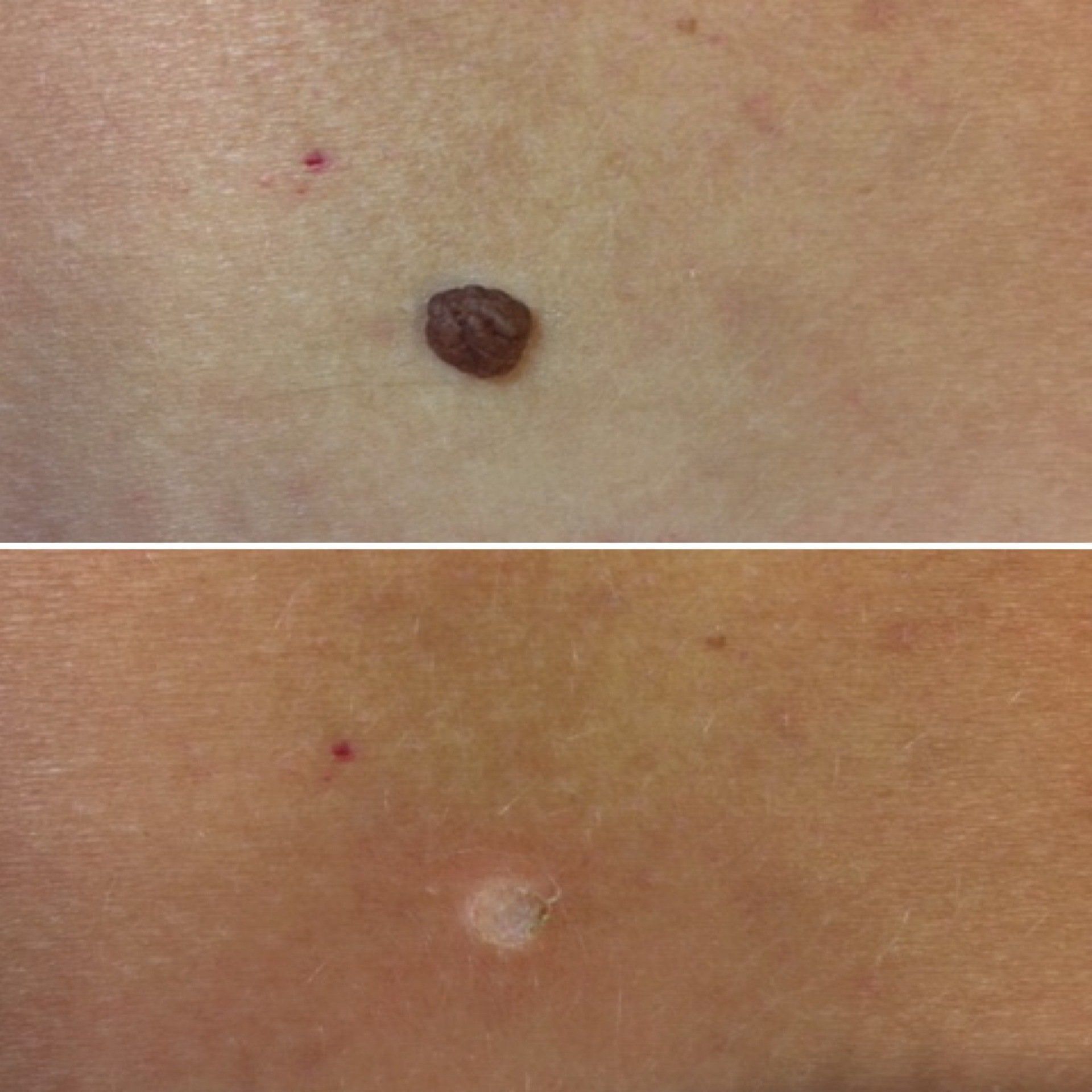 Before-after Dermatosis Papulosa Nigra removal