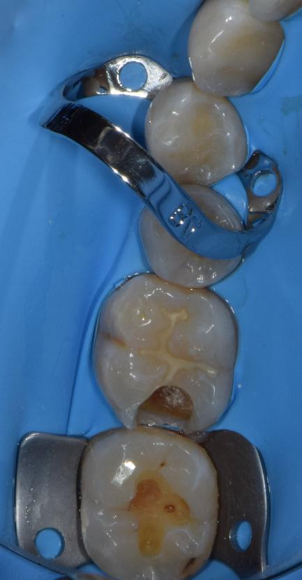 foto dente con carie