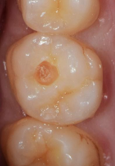 primo piano dente cariato