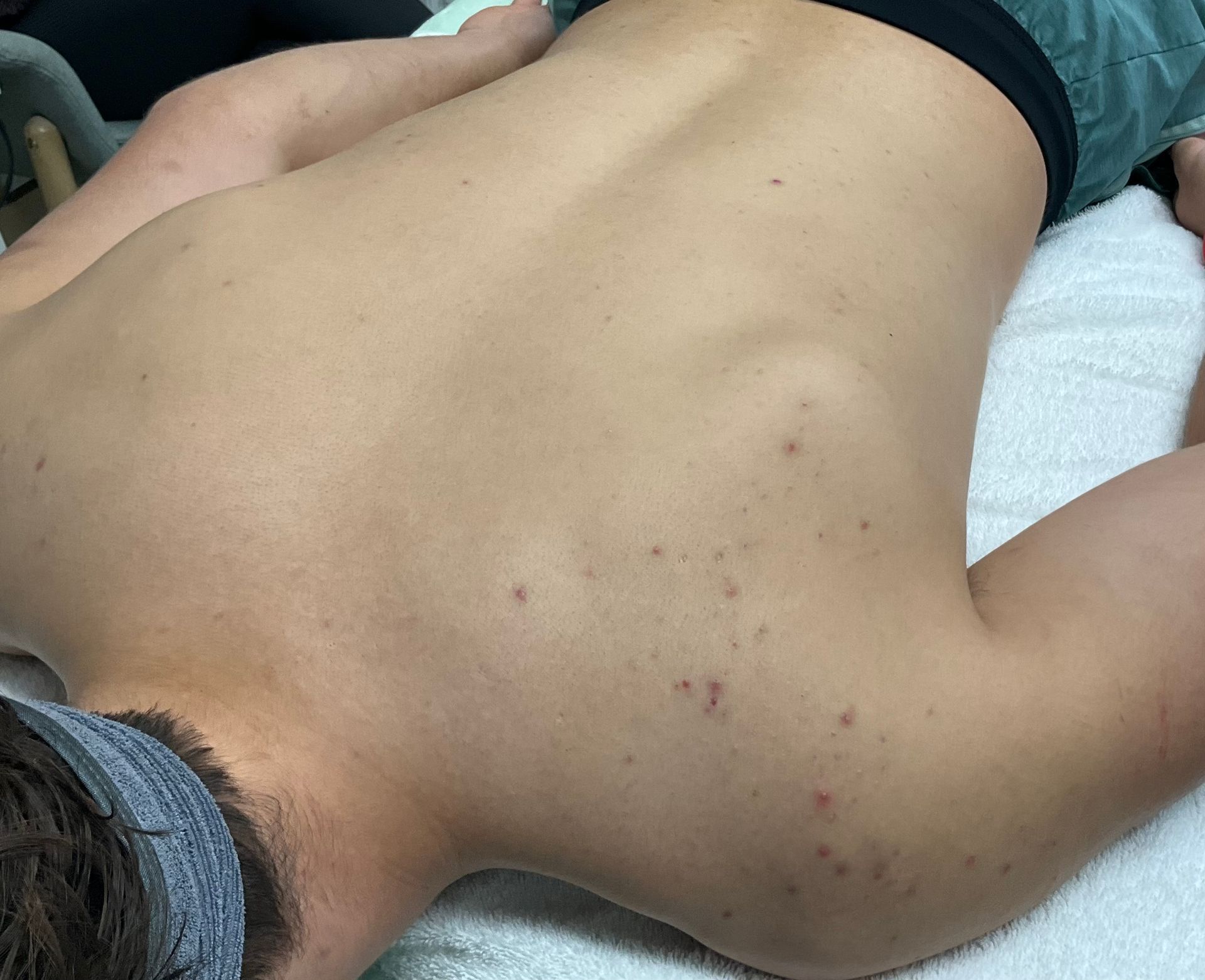 A person lying face down on a white surface, showing their bare back with some red spots and discoloration.