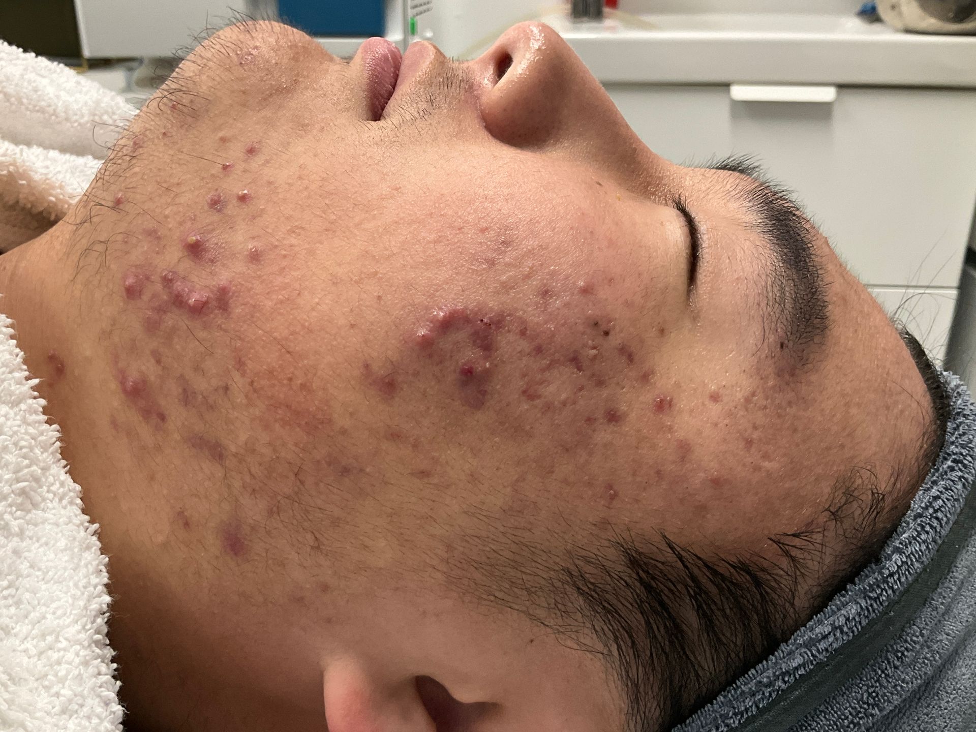 Man's face close-up; acne on cheeks and jawline. He is lying down, eyes closed.
