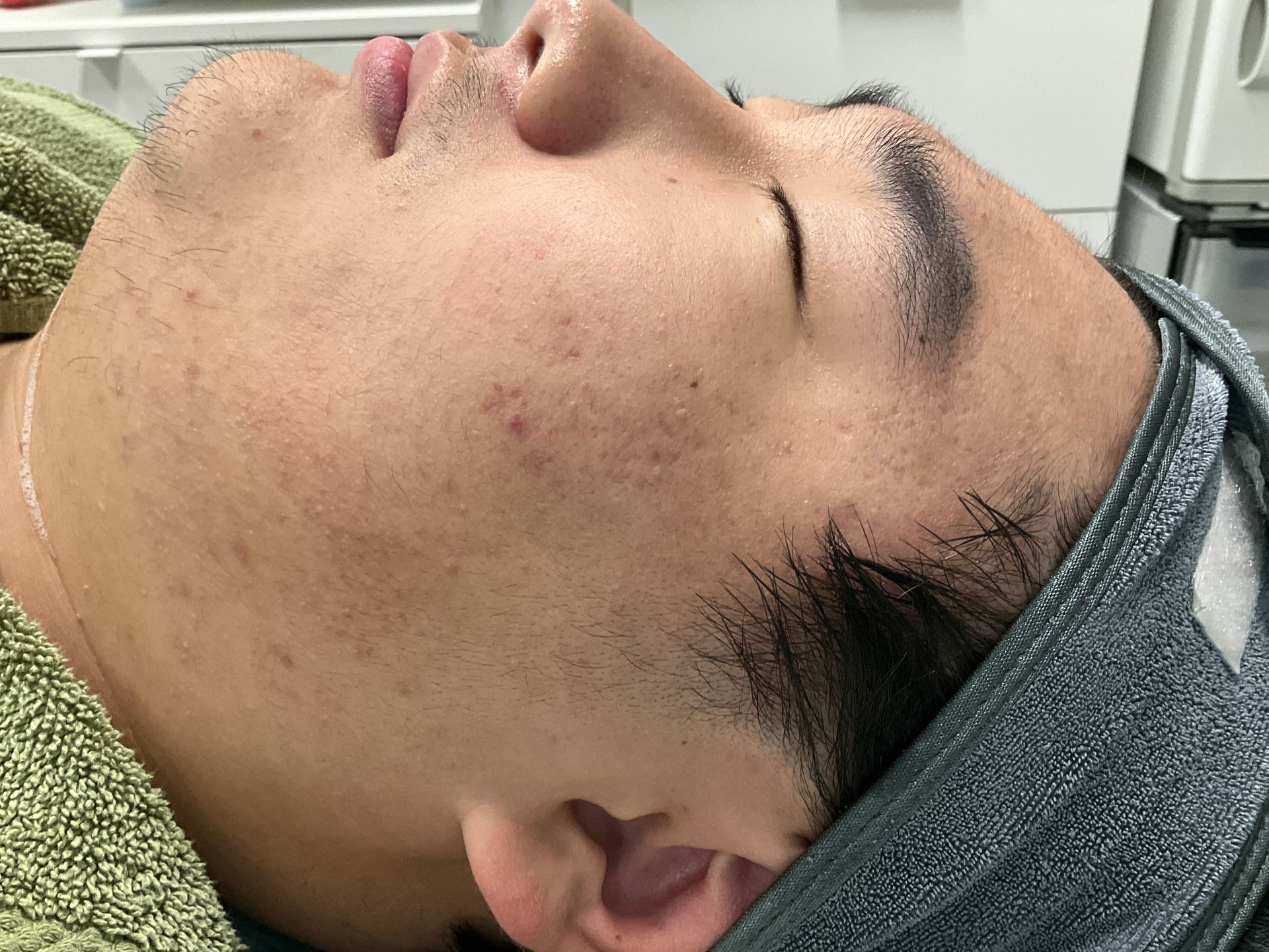 Man's face with closed eyes, possibly receiving facial treatment. Skin has some blemishes.