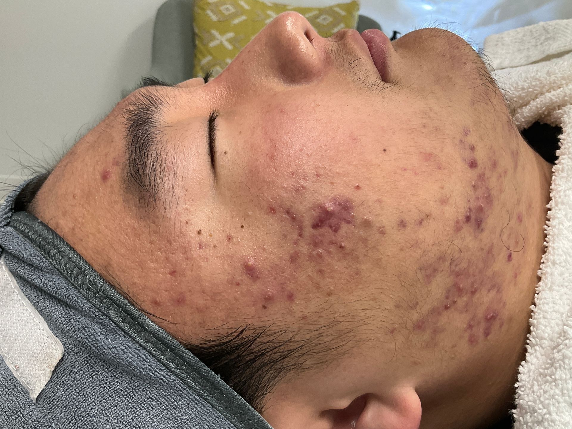 Man's face with acne. Skin is reddish with blemishes. He is lying down with a towel and closed eyes.