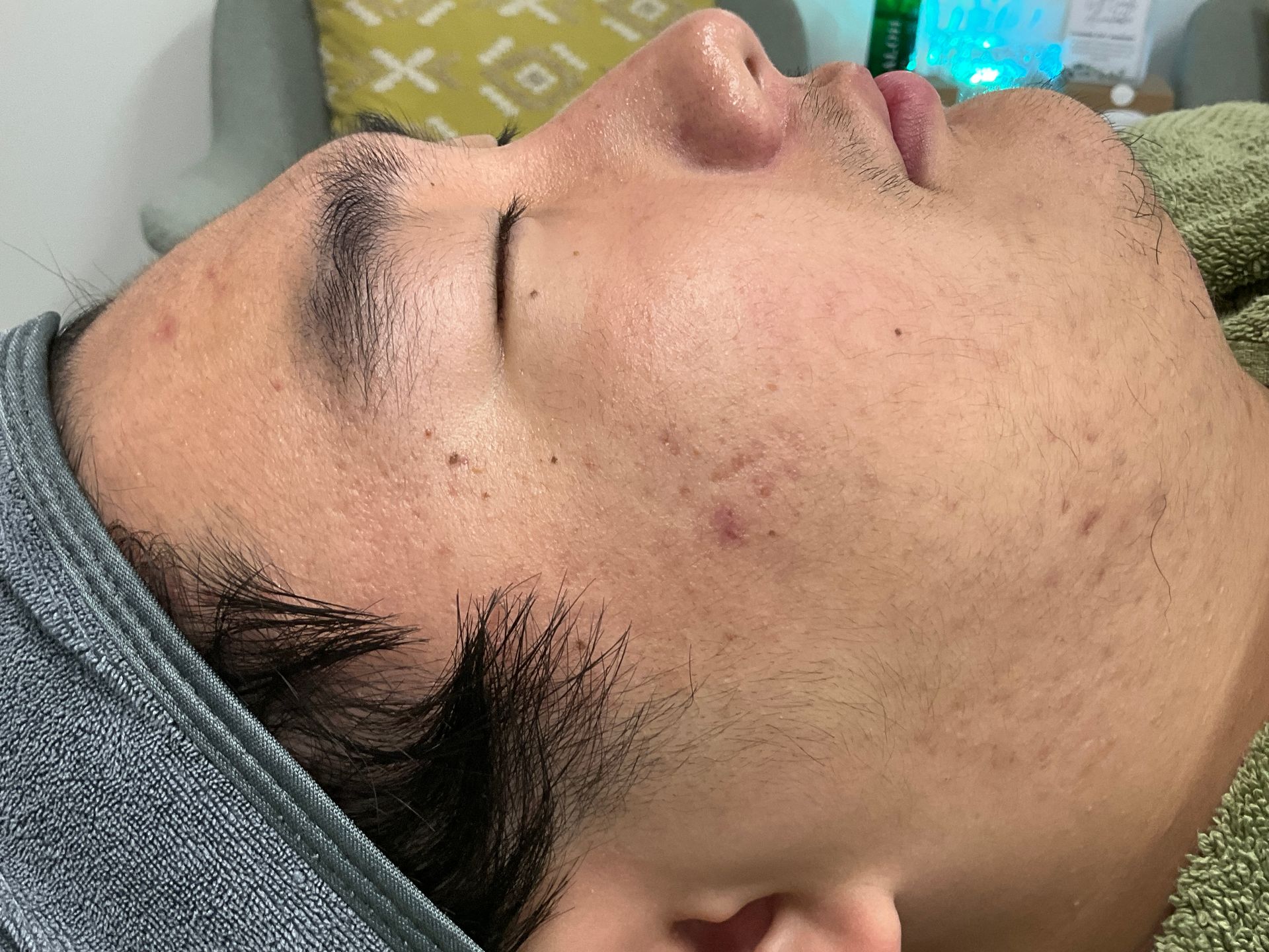 Man with closed eyes and blemishes on face, lying down during facial treatment.