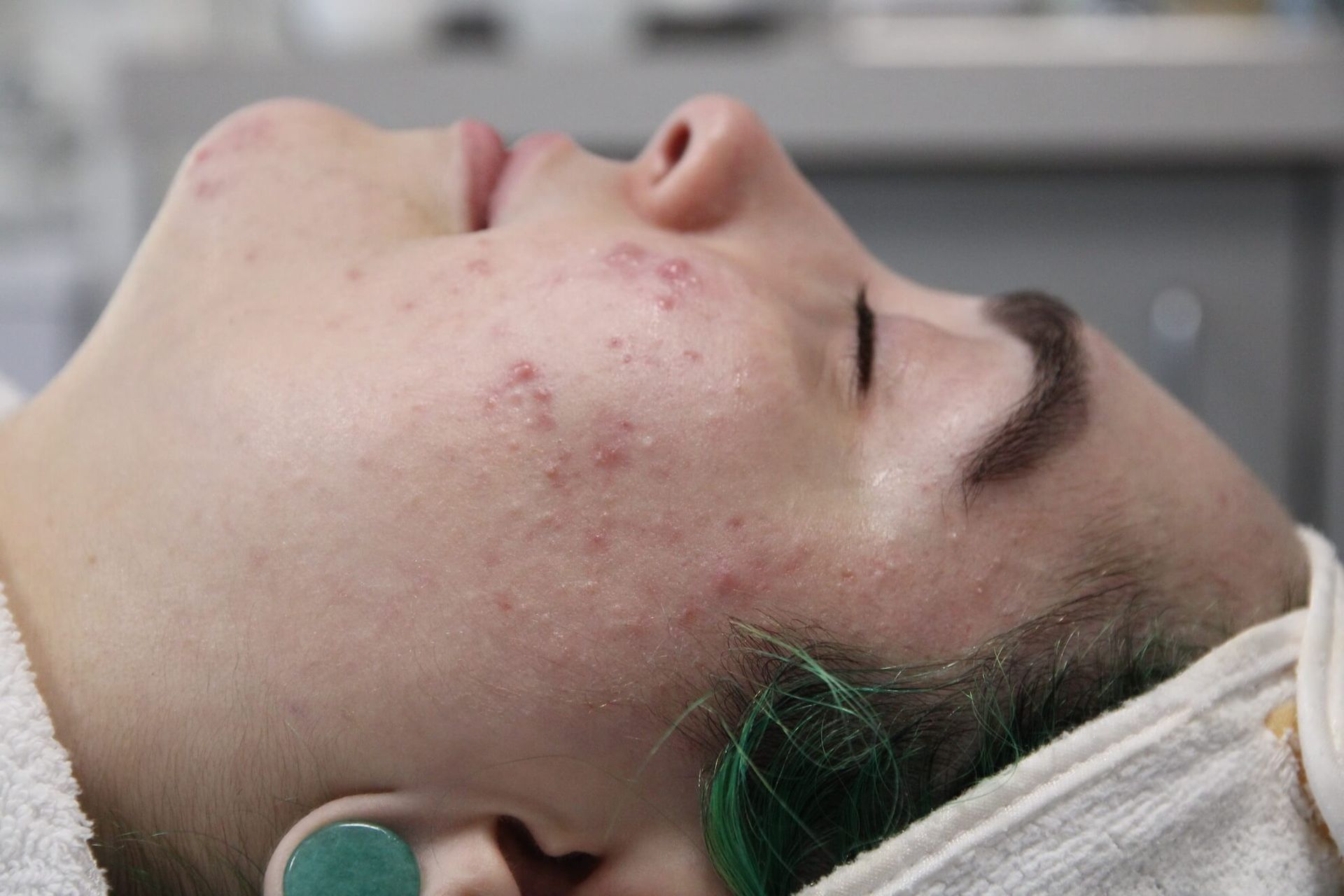 Woman with acne on her cheek, laying down with eyes closed, and towel.