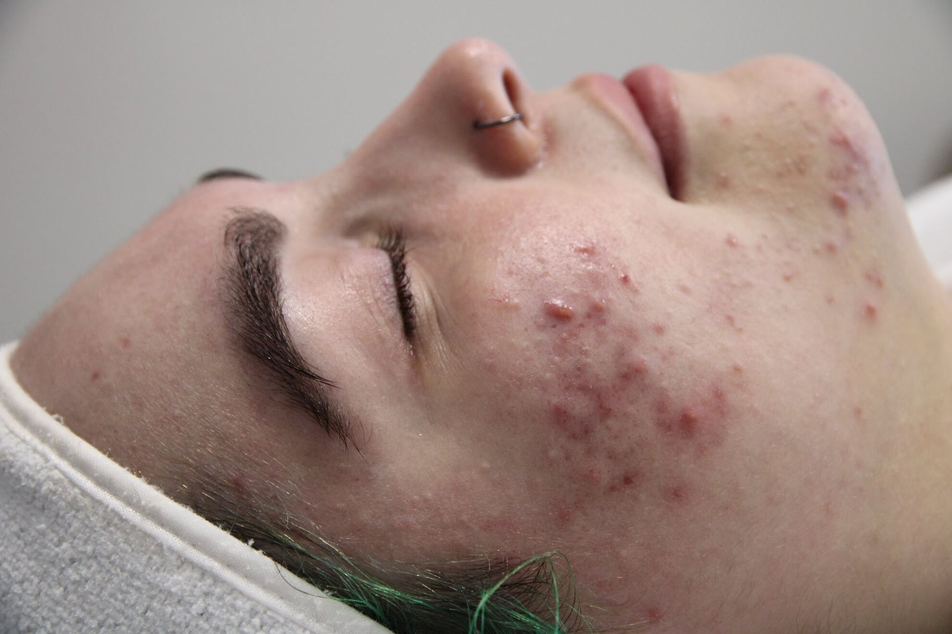 Close-up of a person's face with acne on the cheek and jawline. The person's eyes are closed.