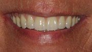 Case 1 After Dental Implant — Hamilton, NJ — Joseph Randazzo DDS