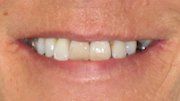 Case 1 Before Dental Implant — Hamilton, NJ — Joseph Randazzo DDS