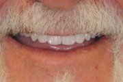 Case 1 After Implant Retained Dentures — Hamilton, NJ — Joseph Randazzo DDS