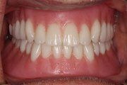 After Implant Retained Dentures — Hamilton, NJ — Joseph Randazzo DDS