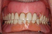 Before Implant Retained Dentures — Hamilton, NJ — Joseph Randazzo DDS