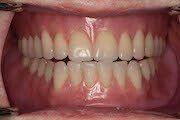 Case 2 After Dentures — Hamilton, NJ — Joseph Randazzo DDS