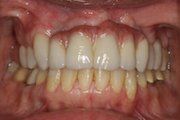 After Dental Rehabilitation for Adults — Hamilton, NJ — Joseph Randazzo DDS